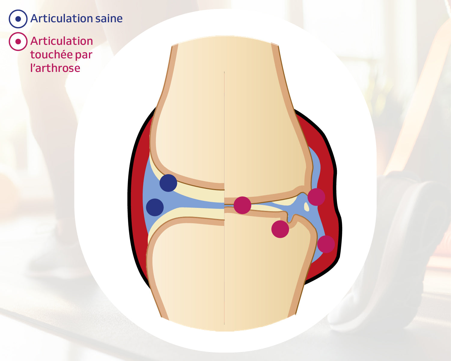 Illustration comparative d'une articulation saine et d'une articulation atteinte d’arthrose, montrant les différences anatomiques et inflammatoires au niveau du genou.
