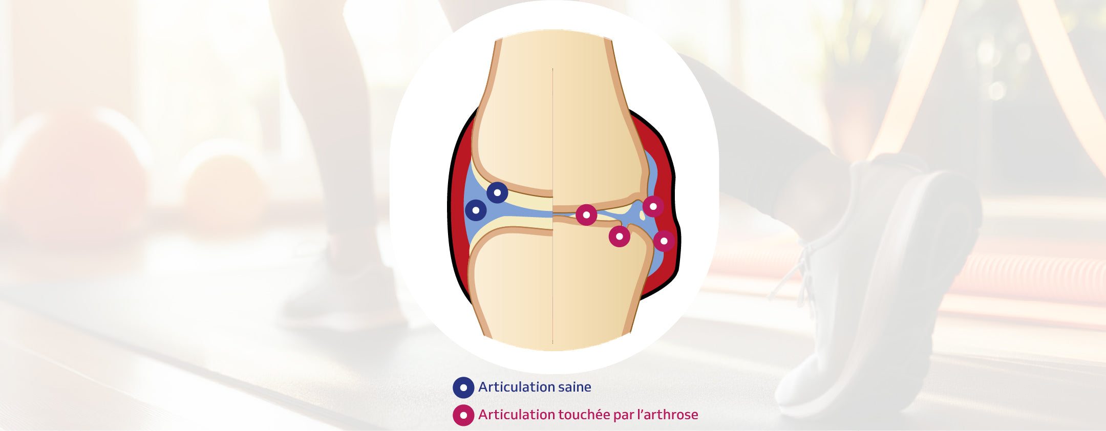 Illustration comparative d'une articulation saine et d'une articulation atteinte d’arthrose, montrant les différences anatomiques et inflammatoires au niveau du genou.
