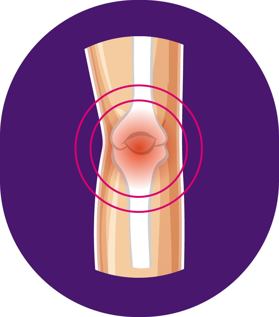 Schéma médical illustrant une articulation du genou avec inflammation, typique de l’arthrose.