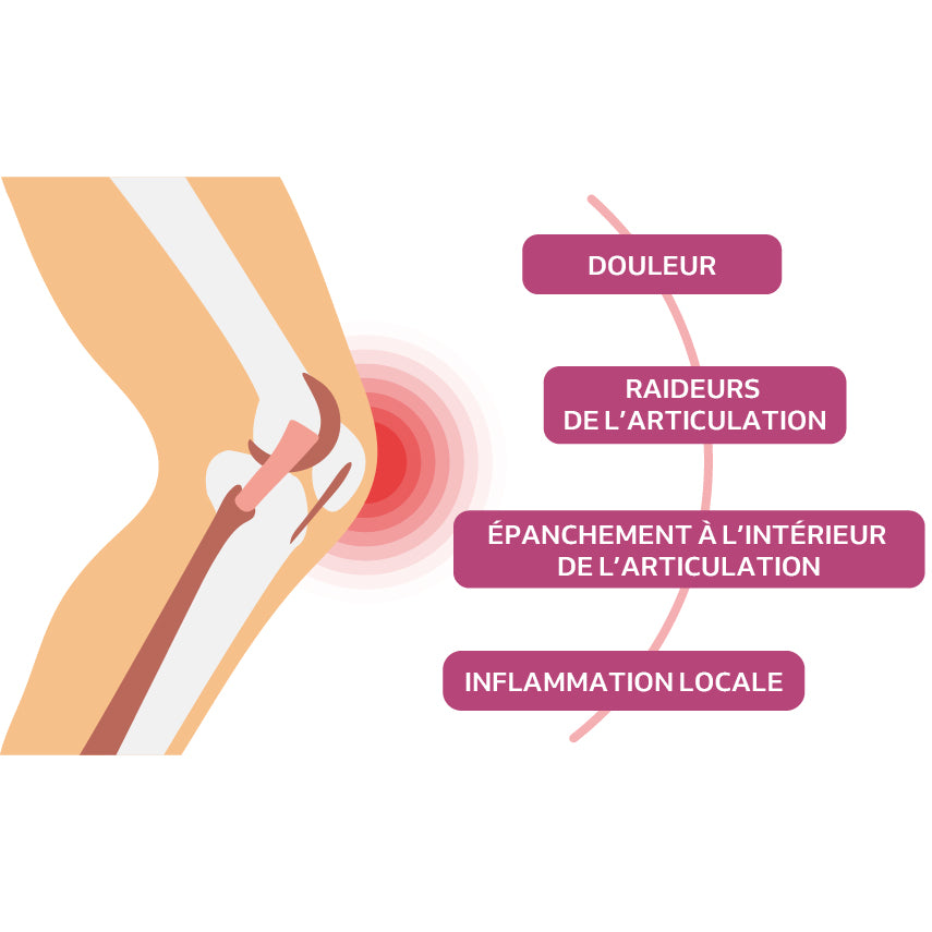 Schéma décrivant les principaux symptômes de l’arthrose du genou : douleur, raideur, épanchement intra-articulaire et inflammation locale.